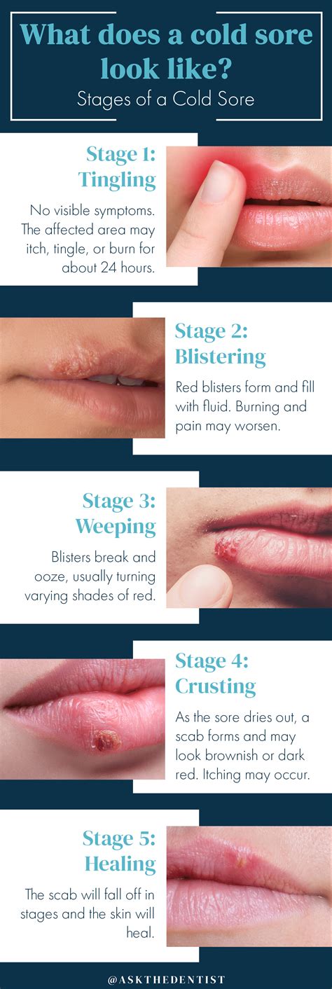 Cold Sores: Pictures, Symptoms, Causes, and Treatments - Fit Coachion