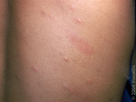 chickenpox   signs  images goodrx