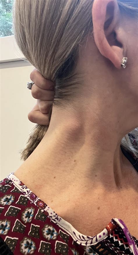 Is this a swollen lymph node? : r/medical_advice