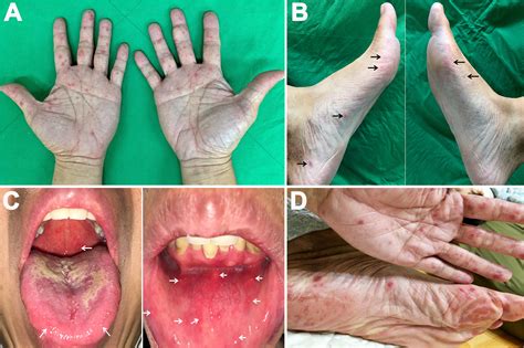 Hand Foot And Mouth Disease In Mouth