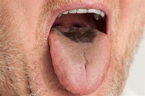 Lingua nera villosa - Le cause, la cura e i rimedi