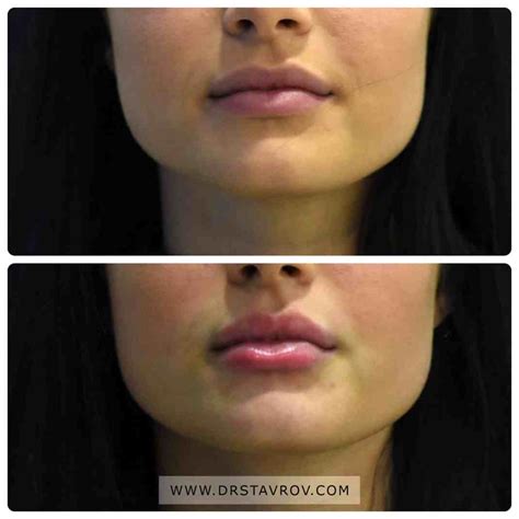Хиалурон в устните. Филъри за устни. Цена - Dr. Stavrov Aesthetics