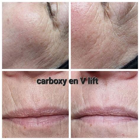 Carboxy CO2 Lift Masker bij Beauty Within Purmerend Centrum