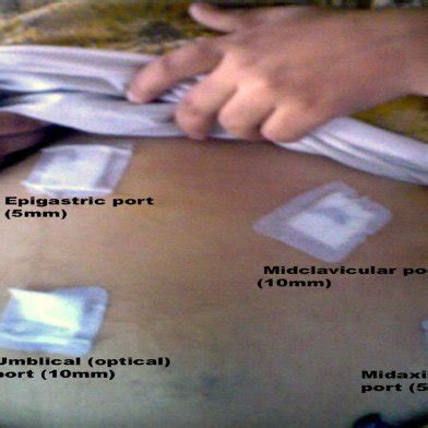 Stone impacted at Hartmann’s pouch. | Download Scientific Diagram