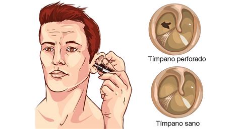 Sintomas De Tímpano Perfurado - Rotura Del Tímpano : Ruptura o perforación del tímpano: síntomas y ...