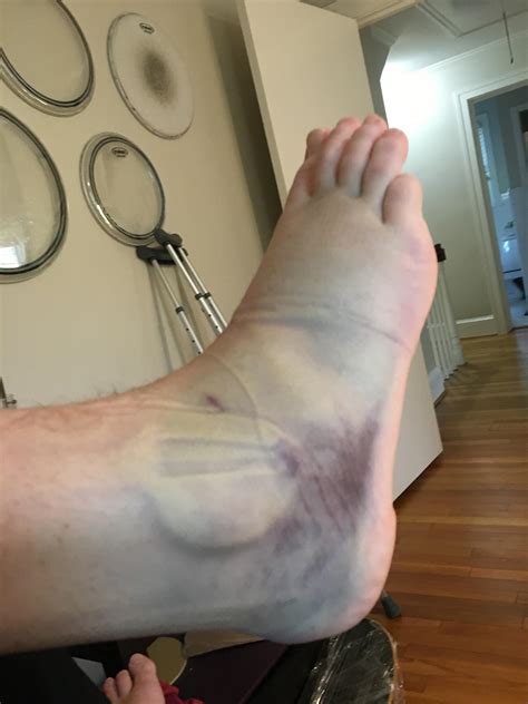 My foot after spraining my ankle last year : r/HadToHurt