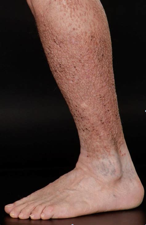 Lichen amyloidosis of the legs | The BMJ