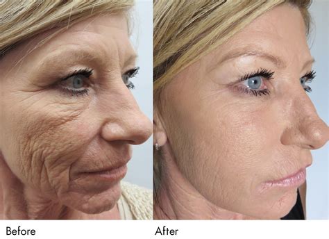 PRP Vampire Facial - Eclat SPA