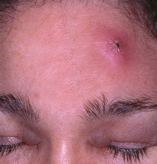 фурункул на лбу Herbal Remedies, Home Remedies, Acne Inversa, Systemic ...