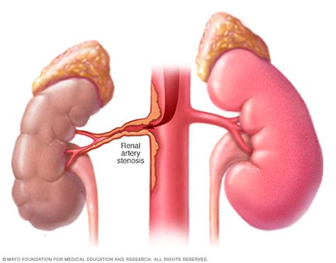 Renal artery stenosis Disease Reference Guide - Drugs.com