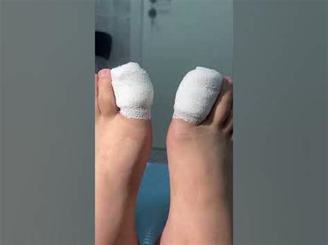Повязки на пальцах после удаления вросших ногтей на обоих больших ...
