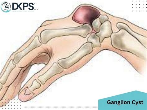 ganglion cyst drsinghphysiocare