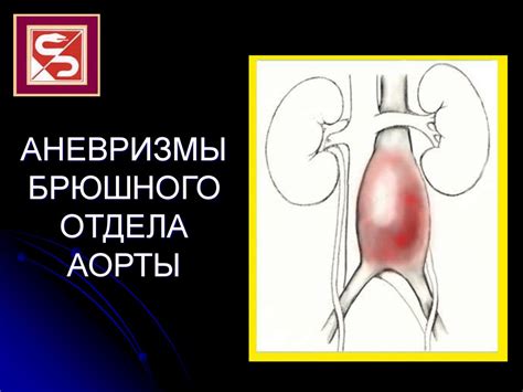 Аневризмы брюшного отдела аорты - презентация онлайн