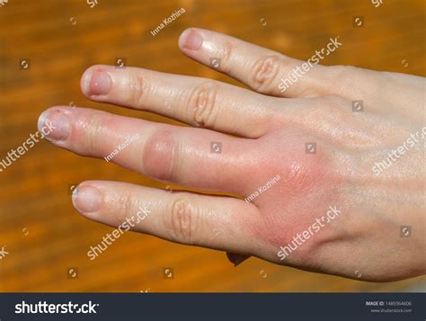 hand  bee bite swelling stock photo  shutterstock