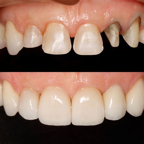 ¿Qué son las carillas de porcelana? | Términos Odontológicos | BQDC