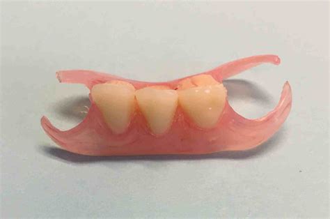 partial denture | Dr. Gentry