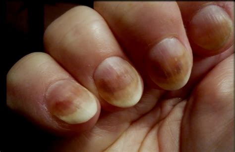 Онихолизис. Что делать? | imkosmetik журнал