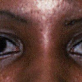 Marfan syndrome. High-arched, narrow palate (Case 5). | Download ...