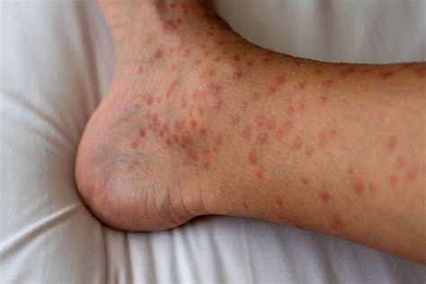 Papular Urticaria: A Guide to This Severe Bug Bite Reaction