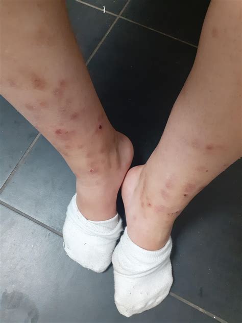 how to get rid of mosquito bite scars 13