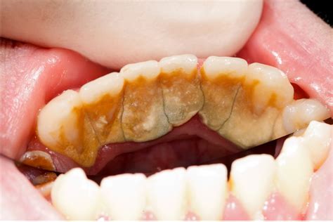 plaque  calculus  nyc dental