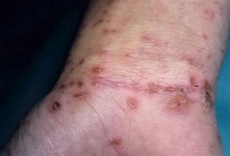 scabies rash treatment symptoms pictures