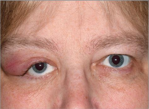Submandibular Lymph Nodes Swollen