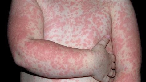 extreme rash  adults  common skin rashes pictures symptoms