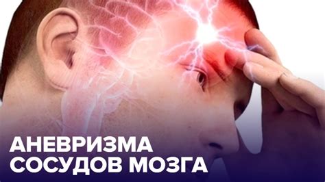 АНЕВРИЗМА сосудов мозга: чем ОПАСНА и как ее обнаружить - YouTube