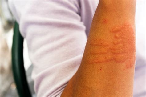 Czym są dermatofity? - Grzybice