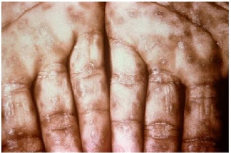 Sifilis - patofisiologi, diagnosis, penatalaksanaan - Alomedika