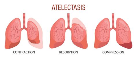 atelectasis diagram