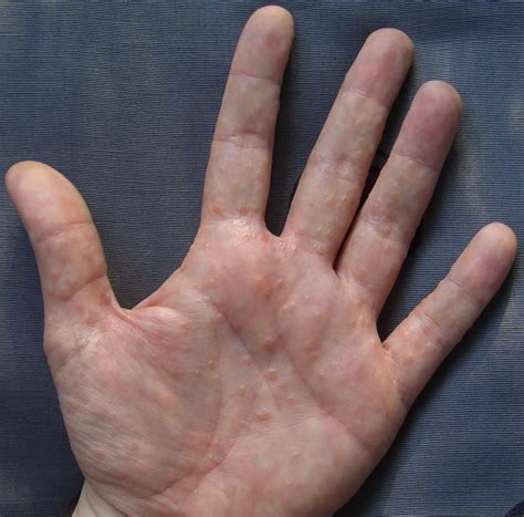 Dyshidrotic Eczema Treatment: Blisters & Cracked Skin - Cutis Dermatology