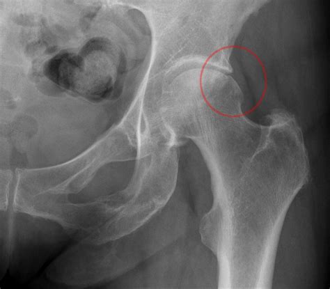 Hip impingement - what is it and how do we treat it?