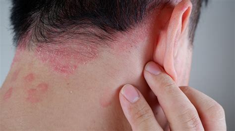facts     psoriasis