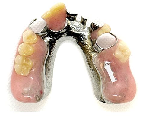 Buy Metal Partial Dentures Online