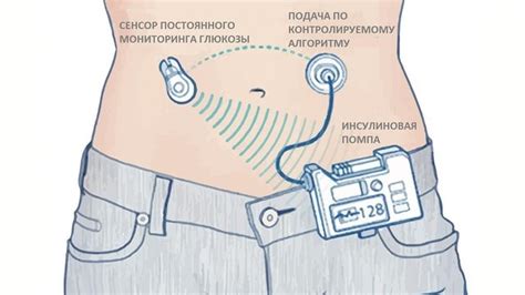 Инсулиновая помпа: что это такое, где получить и как сделать это по ОМС ...