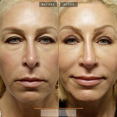 office direct brow lift  washington dc sherber rad