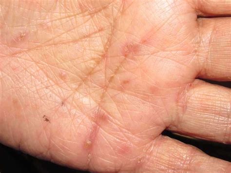Are You Suffering From Scabies Symptoms Causes Preven - vrogue.co