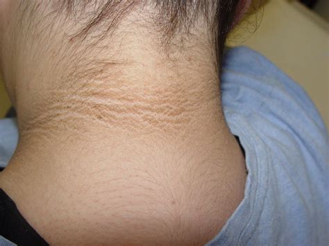 Acanthosis Nigricans [DermTV.com Epi #452] | Skin, Acanthosis nigricans ...