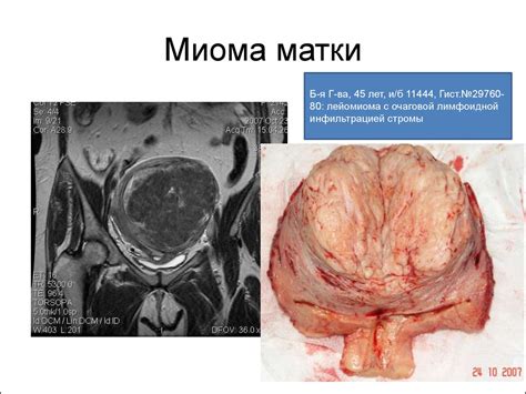 МРТ органов женского малого таза. Доброкачественные образования. Миома ...