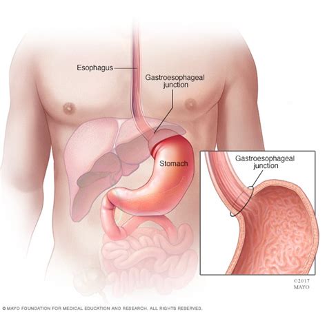 Stomach cancer - Symptoms and causes - Mayo Clinic