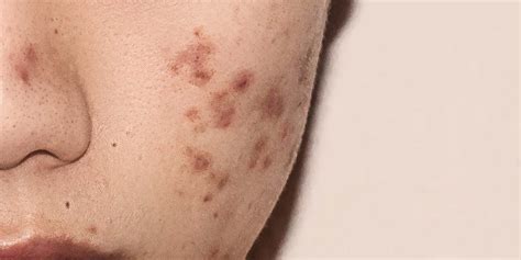 remove dark spots caused  acne inflammation amperna