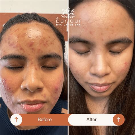 face treatments  afters  nyc med spa