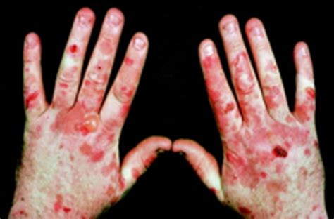 Cutaneous Porphyria (Porphyria)