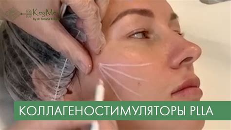 Полимолочная кислота: стимулируем коллаген! - YouTube