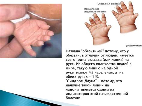 Синдром Дауна - презентация онлайн