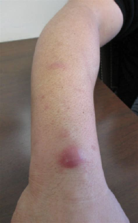 Sporotrichosis | Consultant360