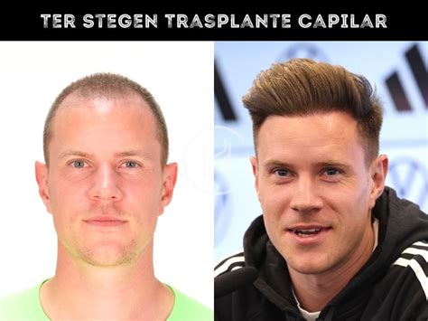 ter stegen trasplante capilar