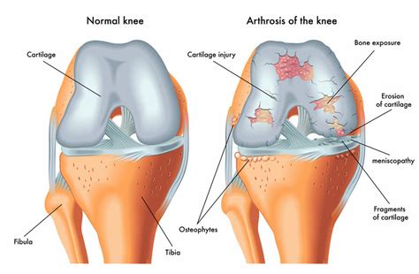 Rehab Exercises For Knee Cartilage Damage - Infoupdate.org